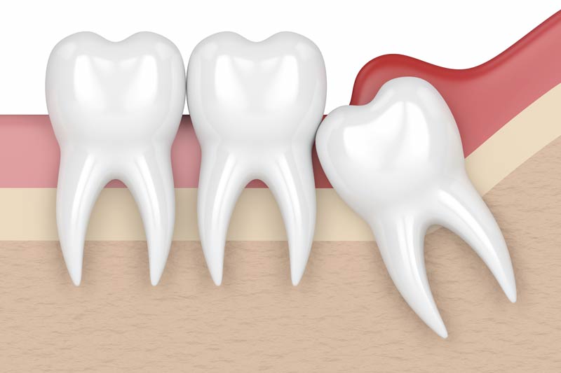 Wisdom Tooth Removal in Glenview